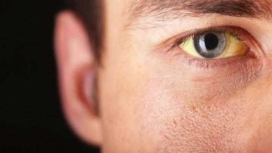 Göz sarılığı nedir? Nasıl tedavi edilir?