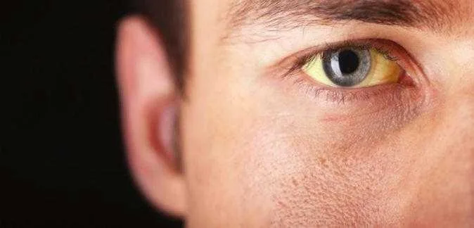 Göz sarılığı nedir? Nasıl tedavi edilir?